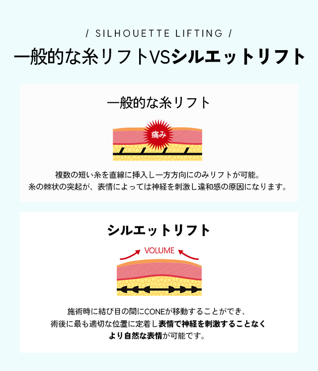 シルエットリフティング 비교 - 糸に固定された棘により顔が動くときに神経への刺激や、不自然さを感じる場合がある。