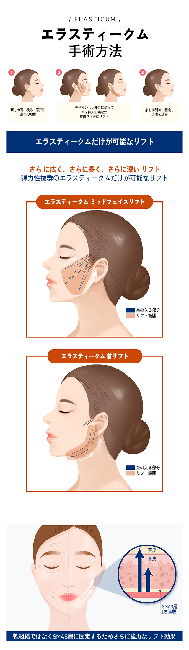 エラスティークム 手術方法 - 1.両方の耳の後ろ、顎下に 最小の切開. 2.デザインした部位に沿って 糸を挿入し突起が 皮膚を十分にリフト. 3.糸を切開線に固定し 皮膚を縫合.